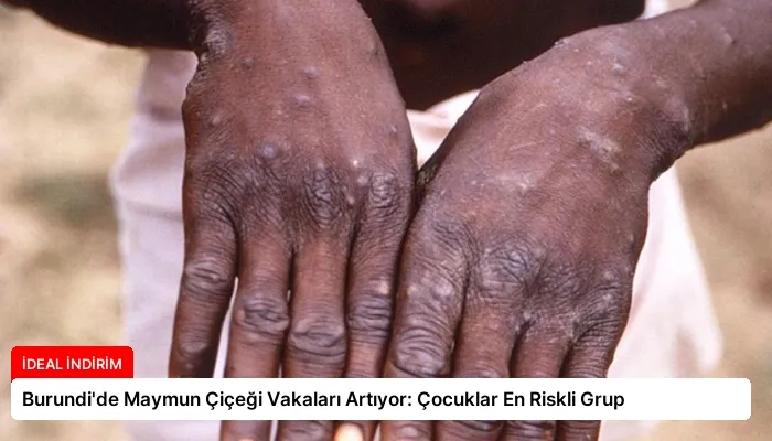Burundi’de Maymun Çiçeği Vakaları Artıyor: Çocuklar En Riskli Grup
